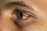 Blood in Eye: Causes, Healing, and When to Worry
