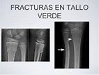 Fractura en tallo verde | Fracturas, Verde, Taller