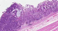 Adenocarcinoma of the stomach | MyPathologyReport.ca