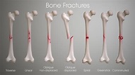 Fracture types , Plaster Of Paris techniques and Complications