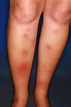Erythema Nodosum Leprosum (Leprosy) - Dermatology Advisor