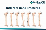 Visual Types Of Bone Fractures Guide Infographic Tv N - vrogue.co