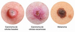 Signos y síntomas del cáncer de piel: Identifícalos a tiempo