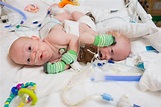 Rare conjoined twins successfully separated