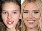 Scarlett Johansson Plastic Surgery – Before and After Photos - Follow News