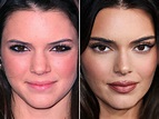 Kendall Jenner Before and After: From 2008 to 2022 - The Skincare Edit