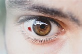 Eye haemorrhage: Causes and treatments | All About Vision