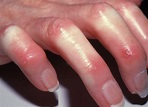 Scleroderma - Symptoms, Pictures, Causes, Treatment, Complications ...