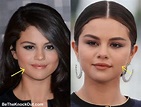 Selena Gomez Plastic Surgery Comparison Photos