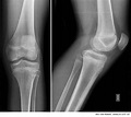 Lesiones y variantes normales de la rodilla pediátrica | Revista ...
