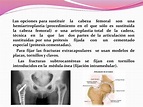 PPT - FRACTURAS DE CADERA PowerPoint Presentation, free download - ID ...