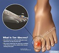 What is Toe Abscess|Causes|Symptoms|Treatment|Home Remedies|Prognosis ...