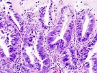 File:Gallbladder adenocarcinoma (2) histopathology.jpg - Wikipedia