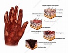 Degree Stages of Burn Injuries, illustration - Stock Image - C039/3474 ...