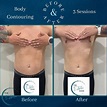 Before and After Body Contouring Photos — Louisville Lymphatic Center