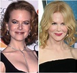 Nicole Kidman’s Before and After Photos Look Different, but She Denied ...