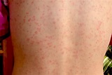 Scarlet fever: Causes, symptoms, treatment, and complications | Strep ...
