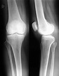 Radiografía de la rodilla, frente y perfil: | Radiografia y Perfil