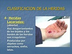 PPT - CLASIFICACION DE LA HERIDAS PowerPoint Presentation, free ...