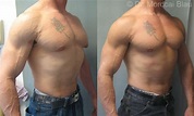 Bodybuilder Gynecomastia - Before and After Photos ⋆ Gynecomastia USA
