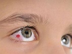 Blood in the eye: What to do, causes and remedies | From Doctor