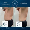 Before and After Body Contouring Photos — Louisville Lymphatic Center