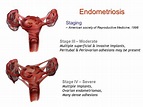 Endometriosis - International Women's Clinic