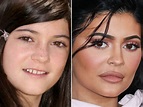 Kylie Jenner Before and After: From 2008 to 2022 - The Skincare Edit