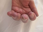 Rheumatologe: Scleroderma / Ulcers on fingers