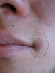 Perlèche (infection des lèvres) : symptômes, causes et traitements