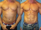 images before (a) and after (B) gynecomastia surgery in a bodybuilder ...