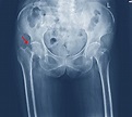 Radiografía de ambas cadera fractura de cuello femoral. | Foto Premium