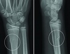 Buckle Fracture - Raleigh Hand Surgery — Joseph J. Schreiber, MD