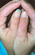 Erythema multiforme - Dermatology Advisor