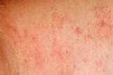 Dr. Kletz, Contact Dermatitis Allergist Washington DC