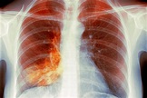 Understanding White Lung Pneumonia: Essential Information - DLatest Scoop