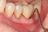 Abscessed Teeth - Perio Peak