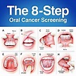 oral-cancer - Spruce Ridge Dental Blog Spruce Ridge Dental Blog