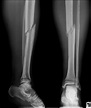 orthopedics - How to tell if my leg fracture is healing? - Medical Sciences Stack Exchange