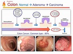 PPT - Pathology Lecture - Neoplasia PowerPoint Presentation, free ...