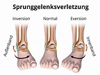 Bänderriss am Sprunggelenk » Ursache, Diagnose, Behandlung