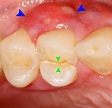 periodontal abscess | DentalDisaster.com