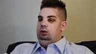 Mitch Hunter Describes His Face Transplant Video - Brigham and Women's ...