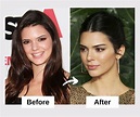 Kendall Jenner Plastic Surgery And Skin Care Secrets - 2022 | Fabbon