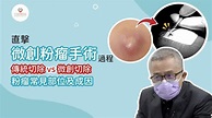 【手術室直擊】微創粉瘤手術｜粉瘤放膿｜粉瘤治療過程｜健康蘋台 - YouTube