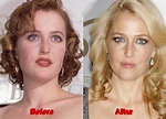 Gillian Anderson Plastic Surgery: Nose Job, Rhinoplasty, Botox