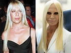 Donatella Versace before and after plastic surgery 04 | Celebrity ...