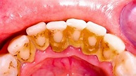 → Tártaro dental: como tratar e não ter nunca mais? – Dr. Wilson Correia