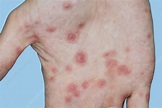 Erythema multiforme rash on hand - Stock Image - C011/5508 - Science ...