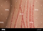 painful surface skin injury bleeding scratches on human male body ...